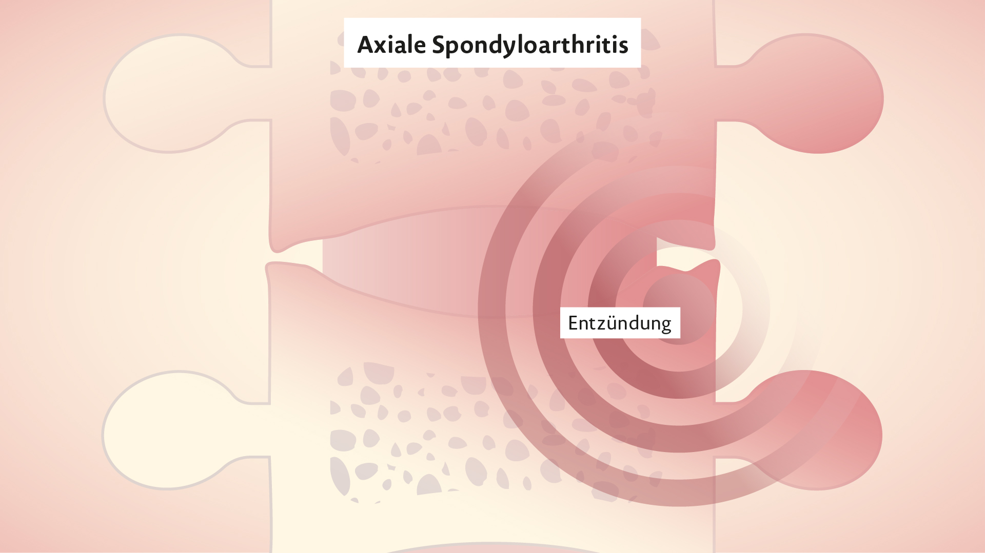 Rinvoq Wirkweise bei Axialer Spondyloarthritis