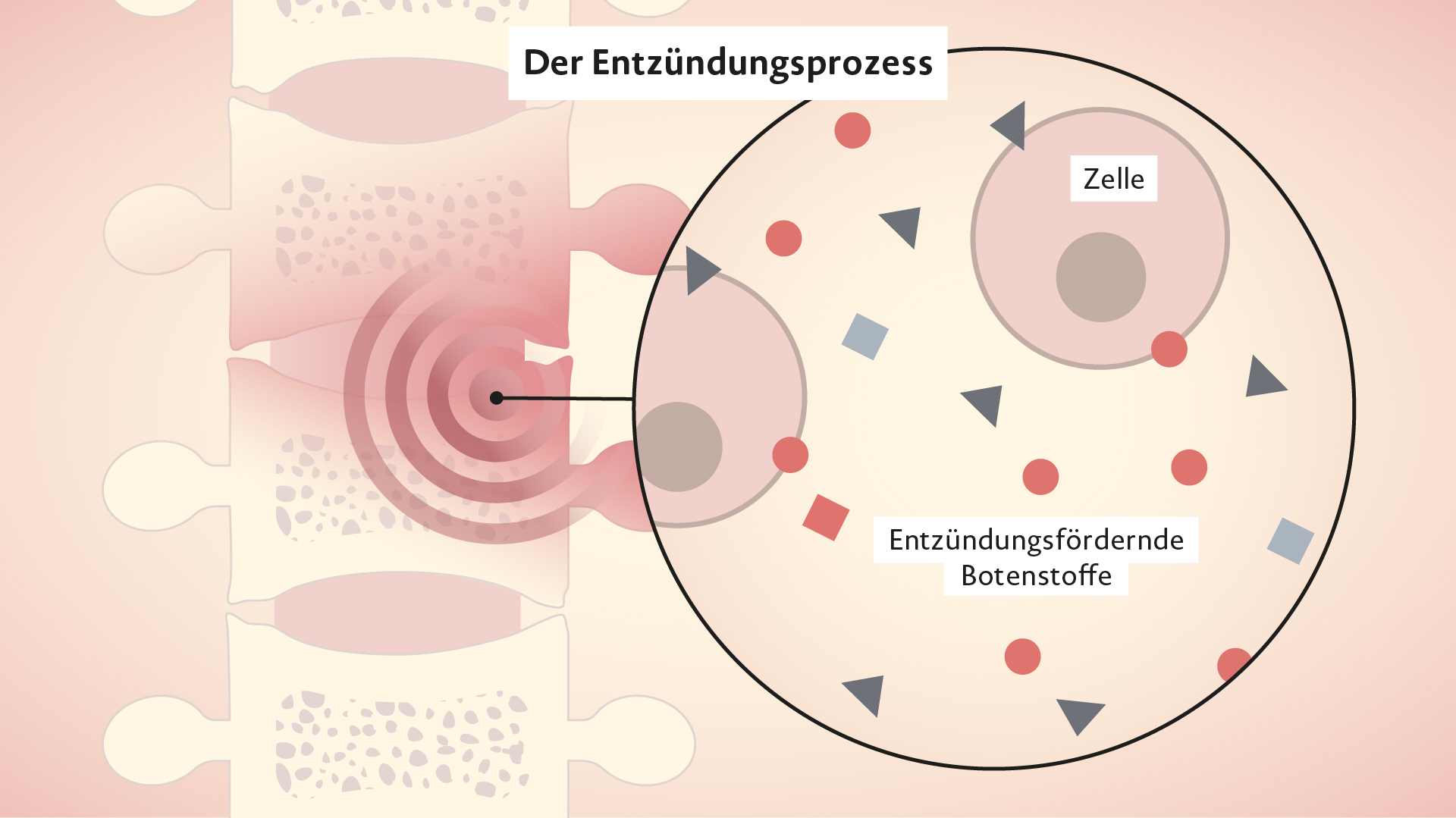 Rinvoq Wirkweise bei Axialer Spondyloarthritis