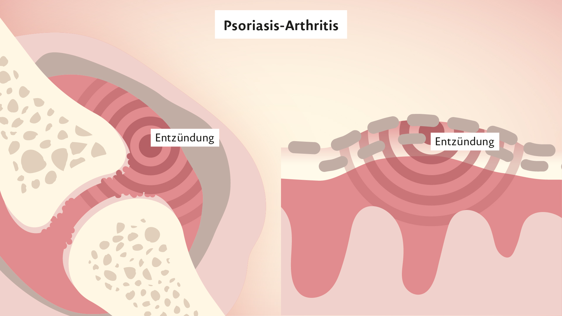 Rinvoq Wirkweise bei Psoriasis-Arthritis