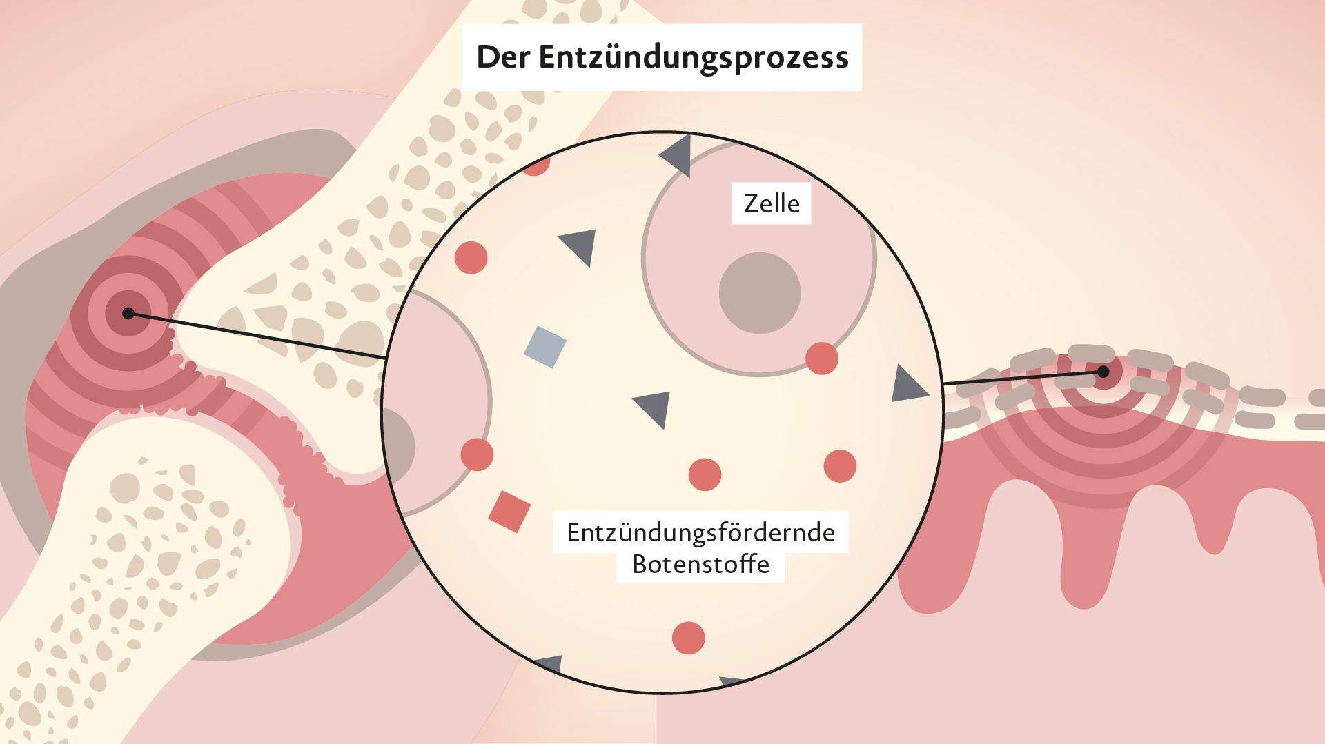 Rinvoq Wirkweise bei Psoriasis-Arthritis