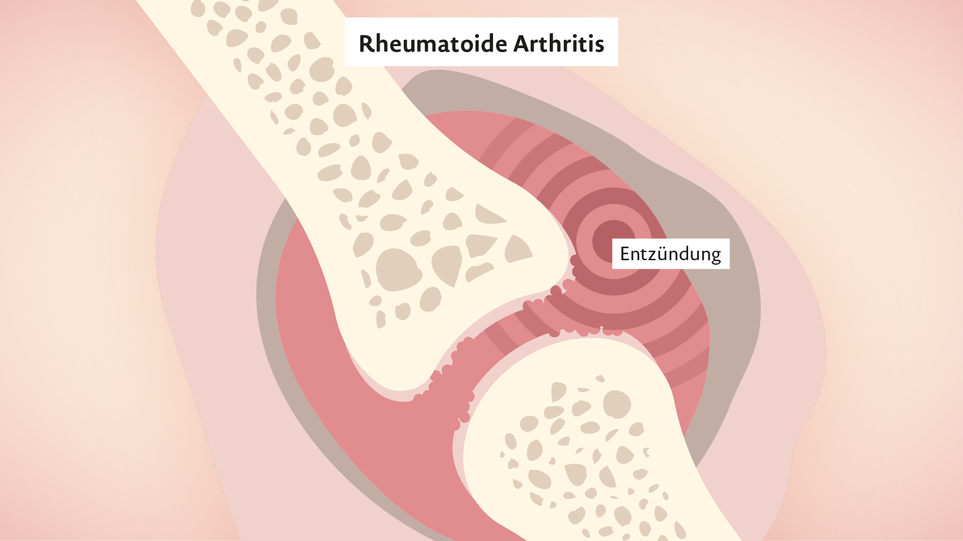 Rinvoq Wirkweise bei Rheumatoider Arthritis