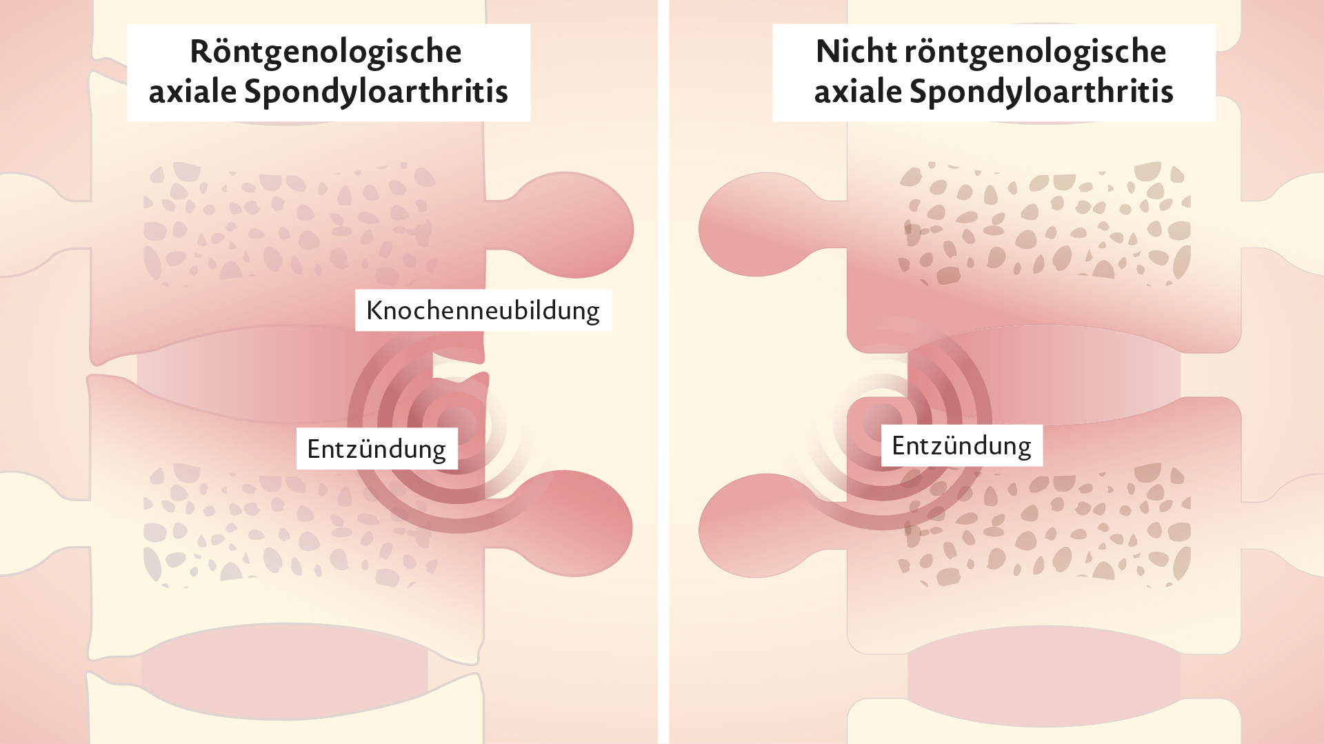 Rinvoq Wirkweise bei axialer Spondyloarthritis