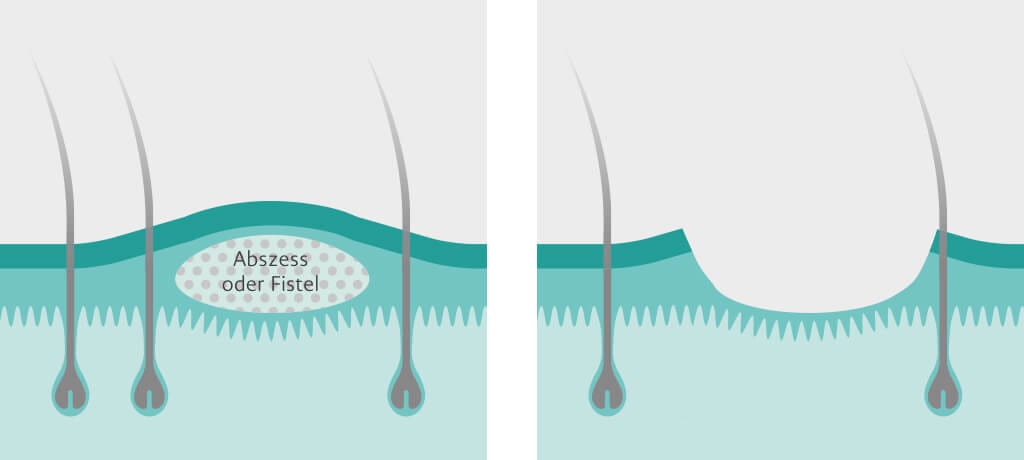 Grafik einer Abdeckelung bei Acne inversa.