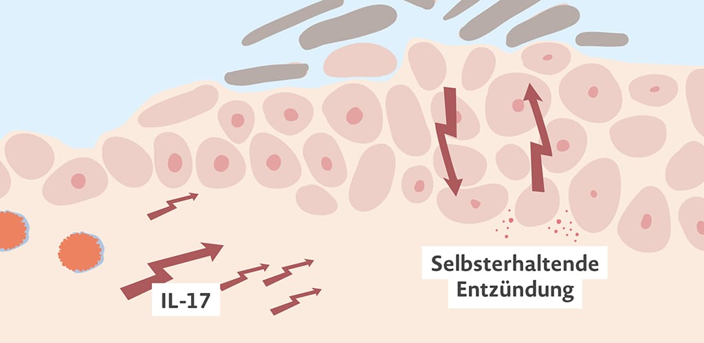 Selbsterhaltende Entzündung