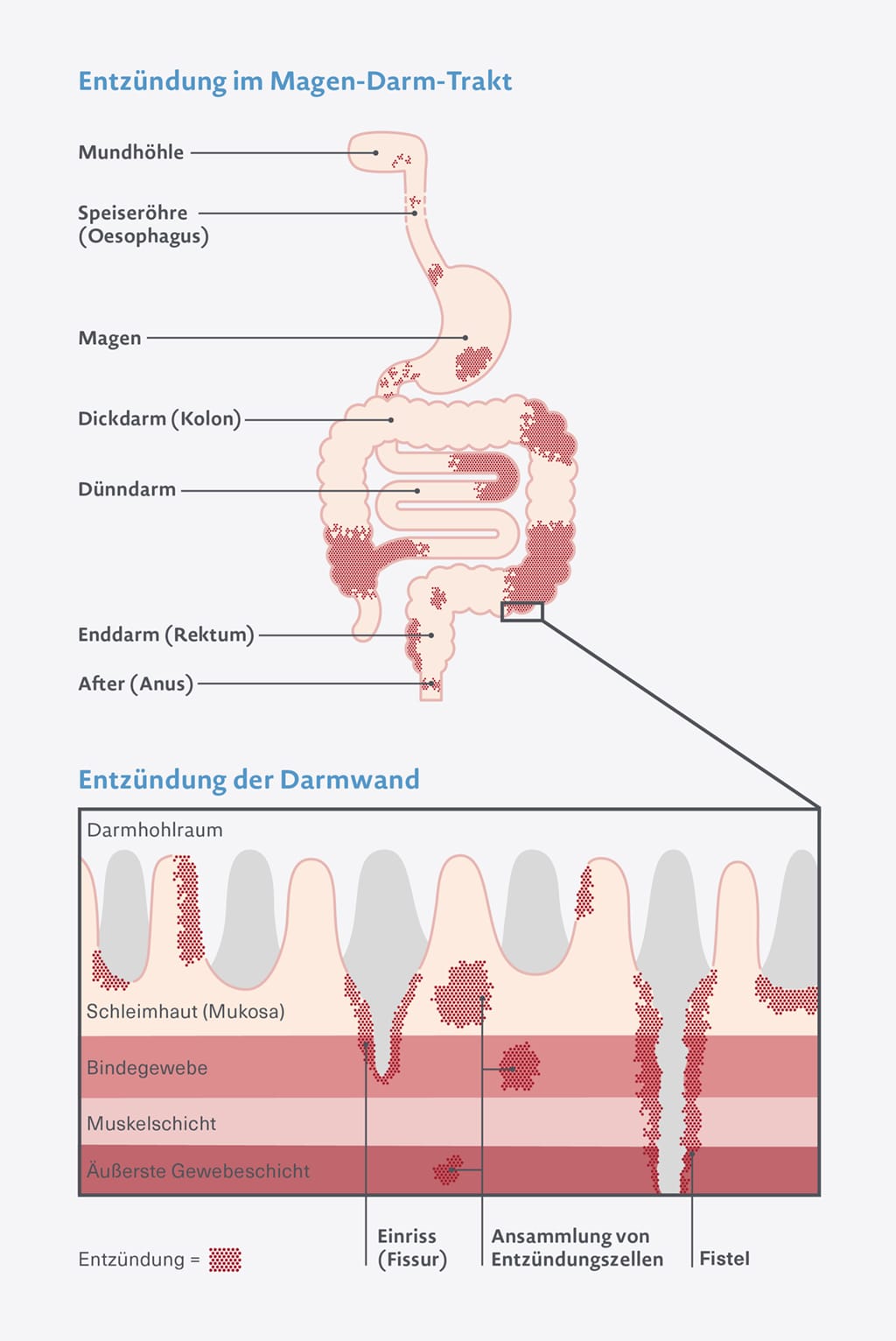 Grafik Entzündung im Magen-Darm-Trakt