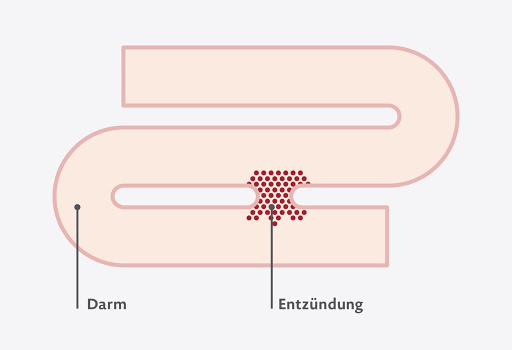 Grafik zu Fisteln und Abszessen