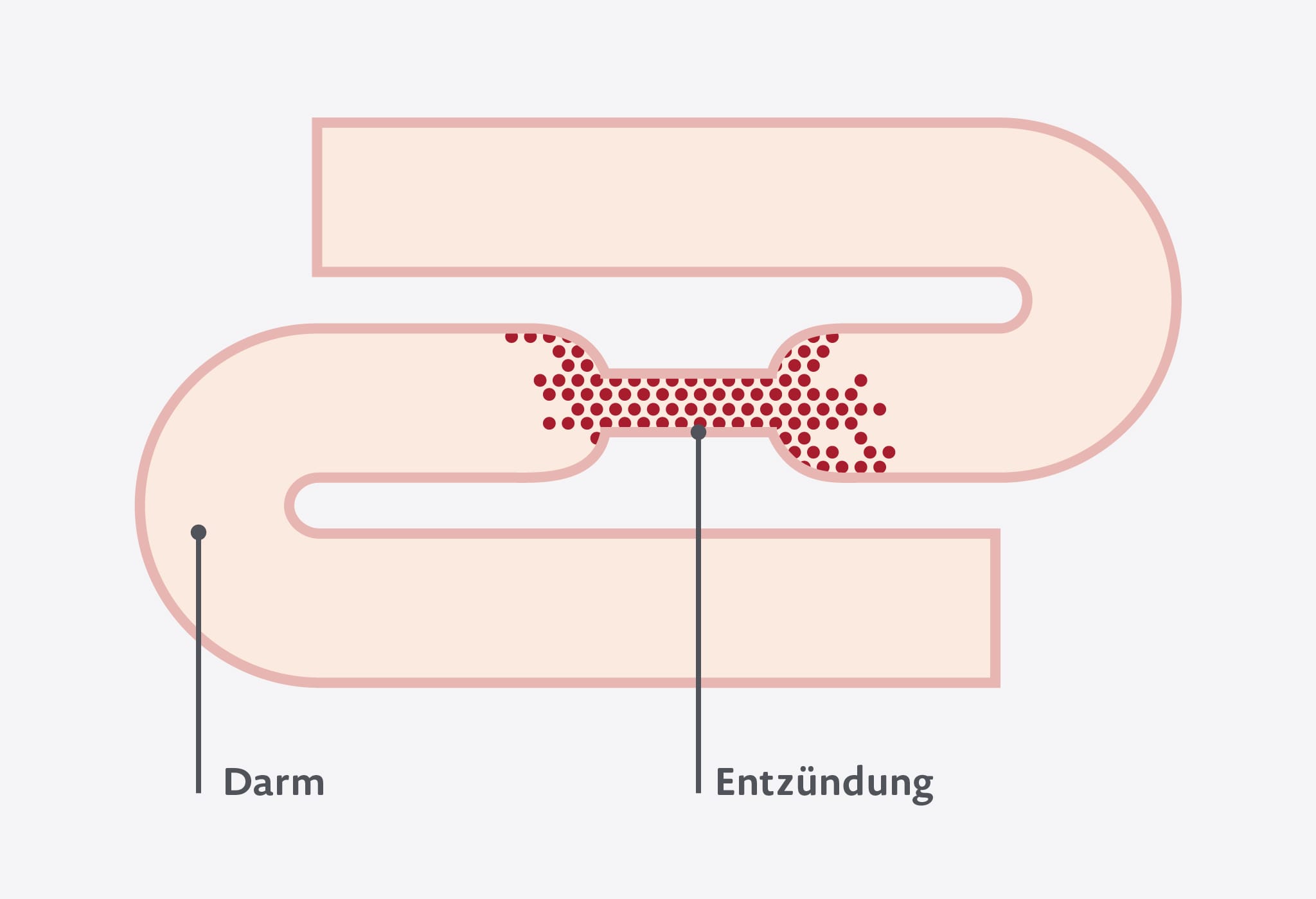 Grafik zu Stenosen