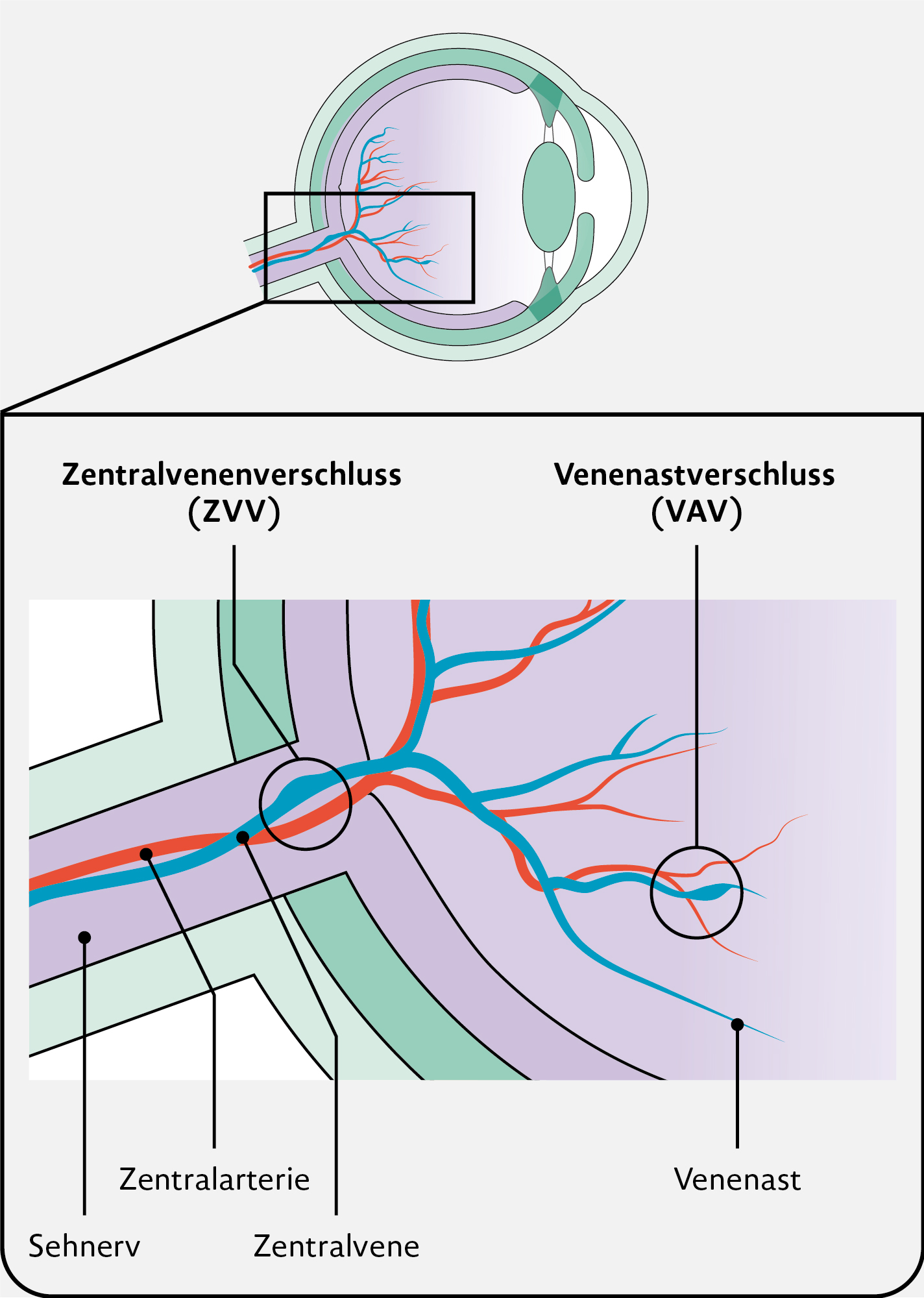 Grafik zum Zentralvenenverschluss