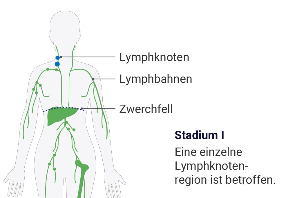 Erstes Stadium der Ann-Arbor-Klassifizierung