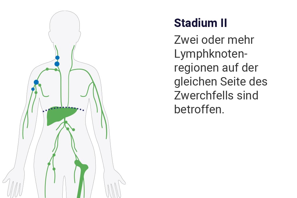 Zweites Stadium der Ann-Arbor-Klassifizierung