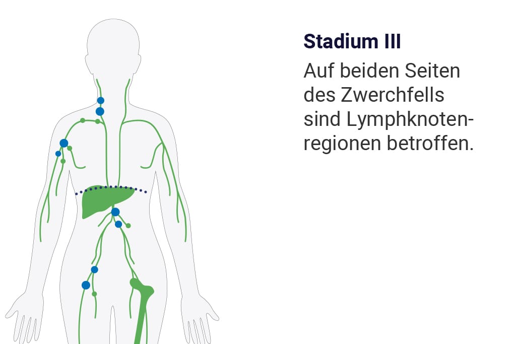 Drittes Stadium der Ann-Arbor-Klassifizierung