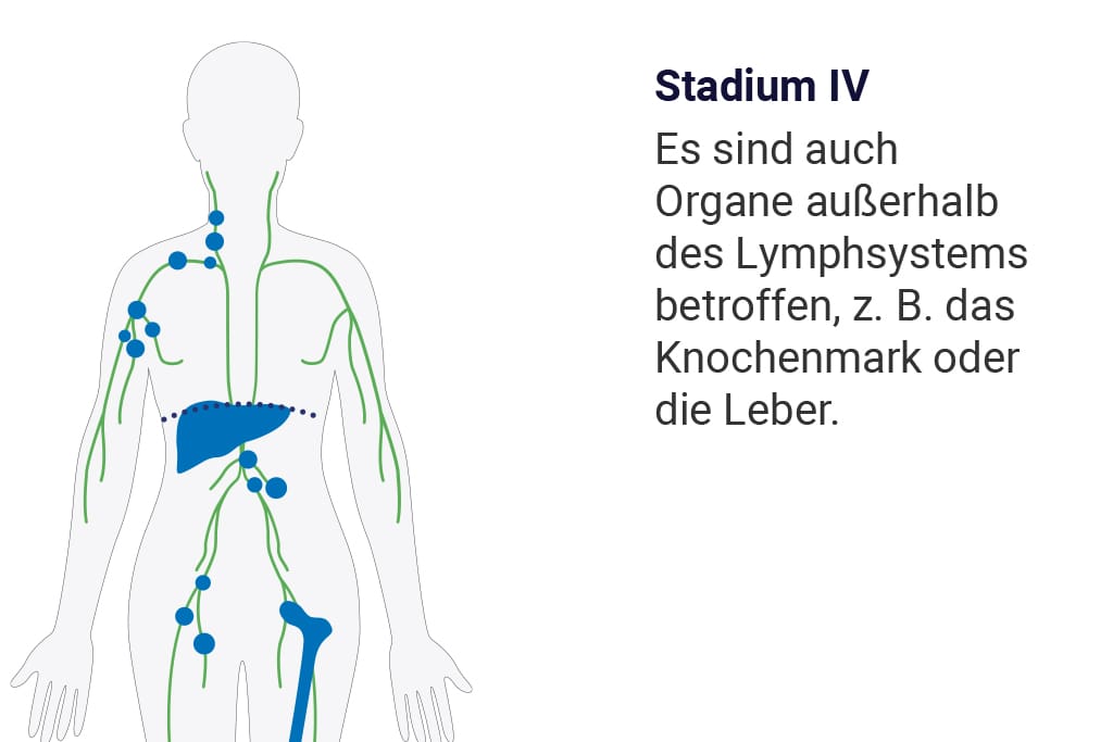 Viertes Stadium der Ann-Arbor-Klassifizierung