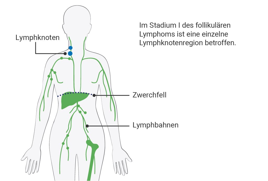 Stadium 1 des follikulären Lymphoms: Darstellung betroffener Lymphknotenregionen