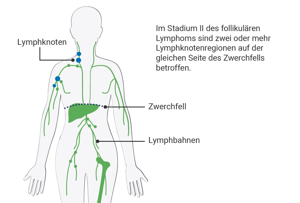 Stadium 2 des follikulären Lymphoms: Darstellung betroffener Lymphknotenregionen