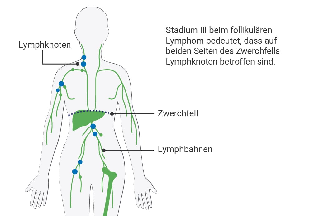 Stadium 3 des follikulären Lymphoms: Darstellung betroffener Lymphknotenregionen