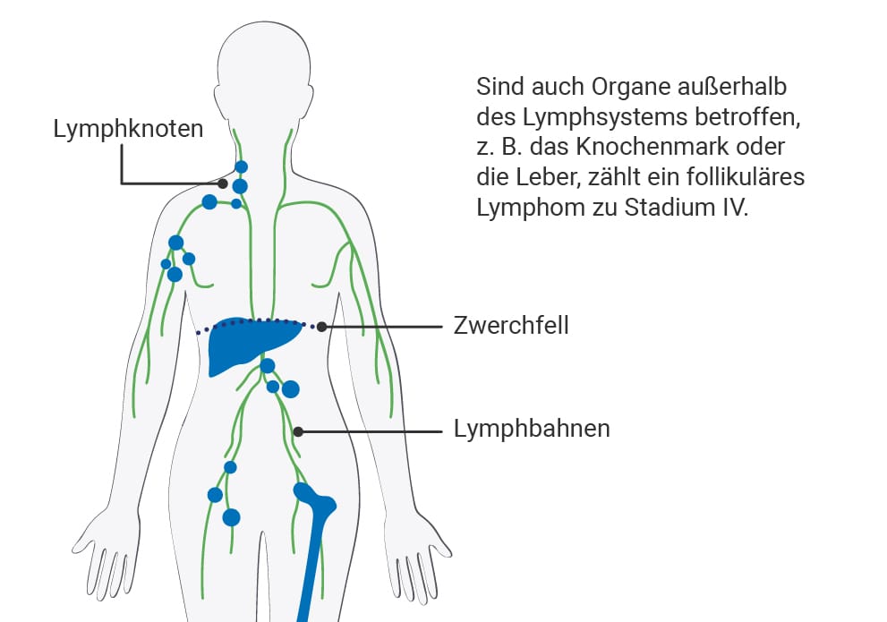 Stadium 4 des follikulären Lymphoms: Darstellung betroffener Lymphknotenregionen