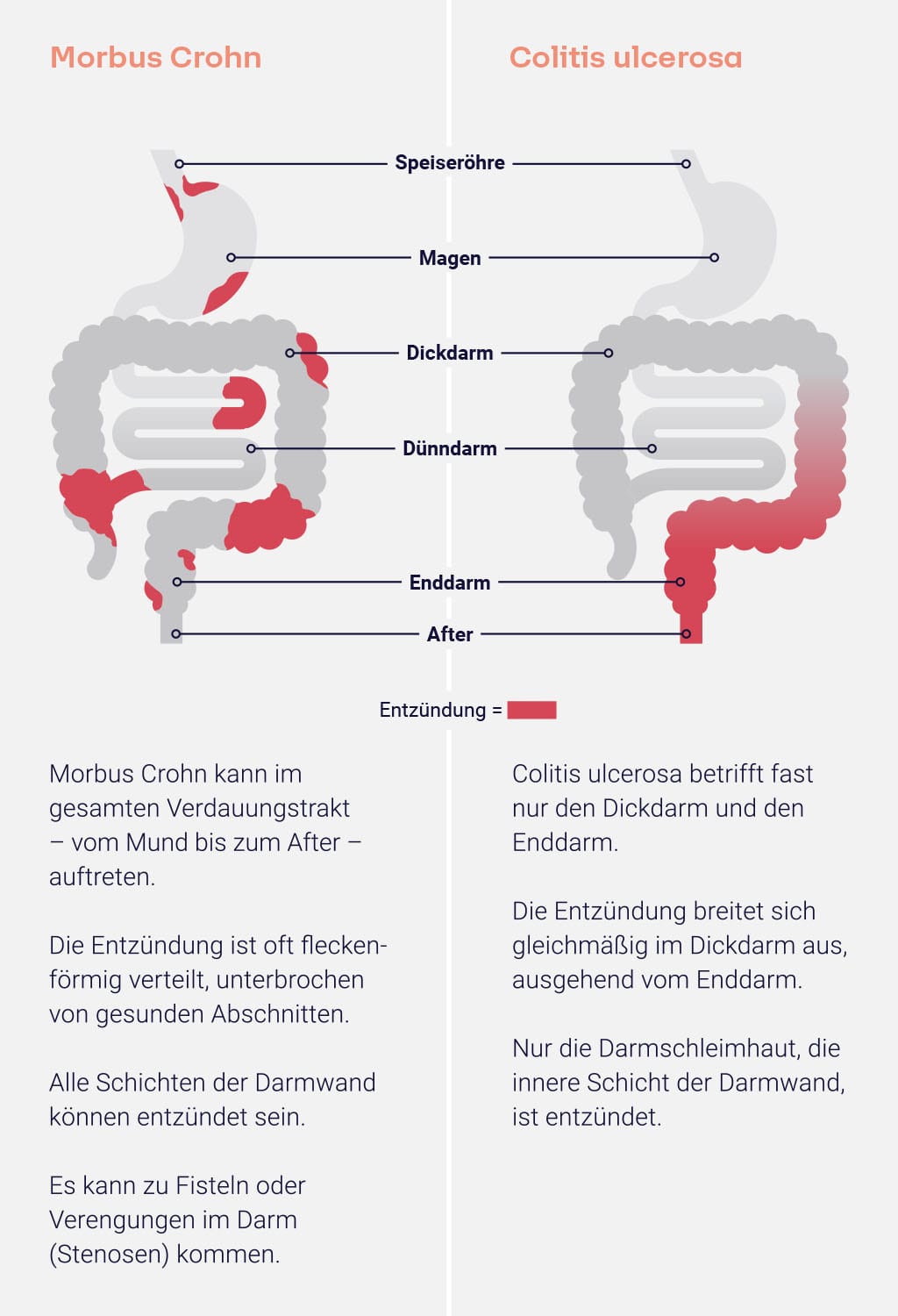 Illustration der Entzündung im Darm bei Colitis Ulcerosa und Morbus Crohn