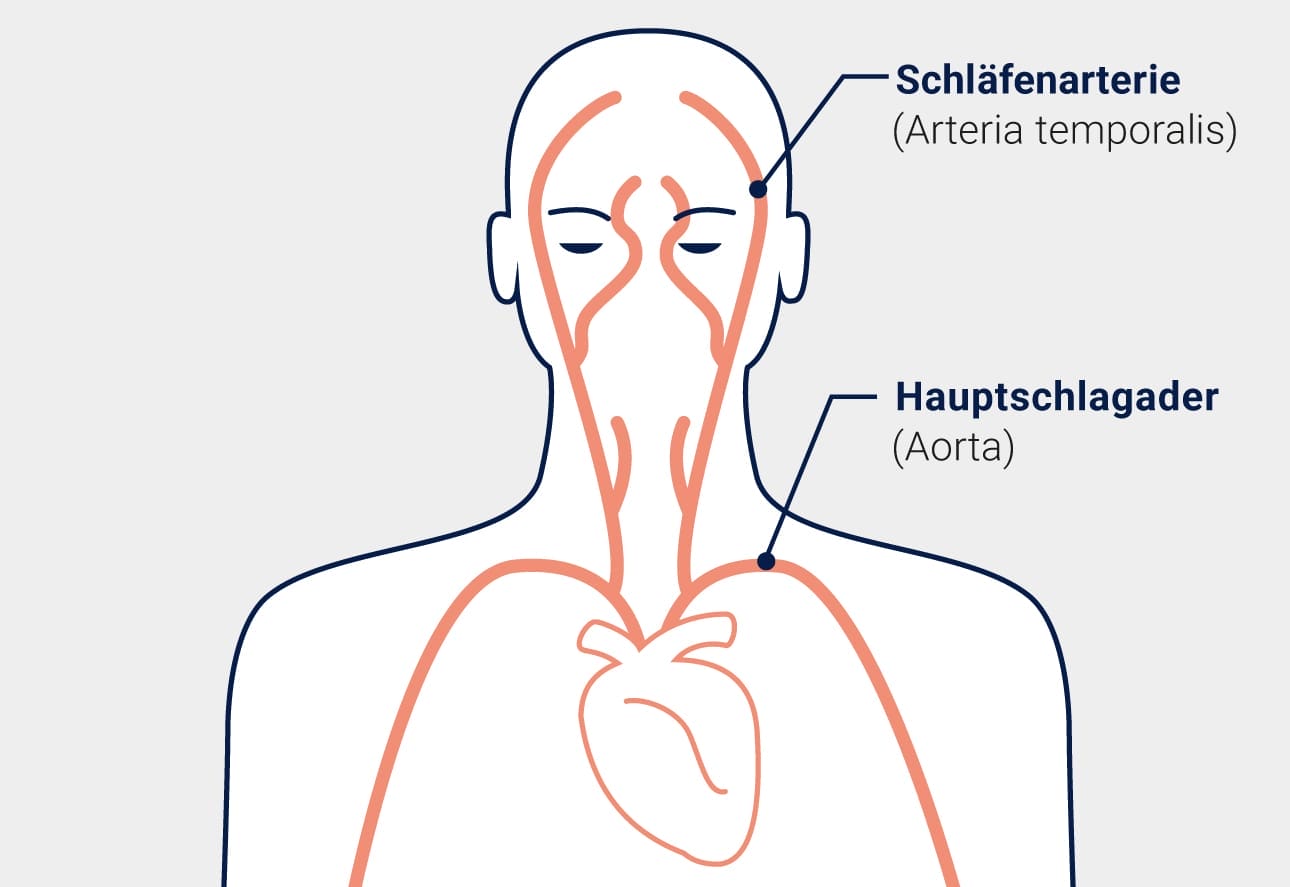 Riesenzellarteriitis: Arterien