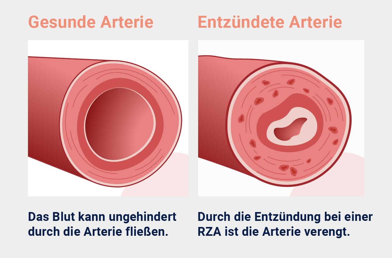 Verengte Arterie bei Riesenzellarteriitis